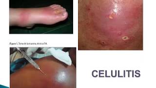 Infecciones de la piel y tejidos blandos   Dra Adriana Romani