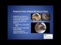 Meniscus Root Tears: Unique Injuries Requiring Anatomic Repair - James Dreese, MD