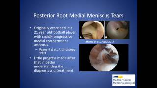 Meniscus Root Tears: Unique Injuries Requiring Anatomic Repair - James Dreese, MD