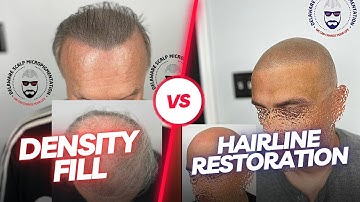 Density Fill vs. Hairline Restoration: What