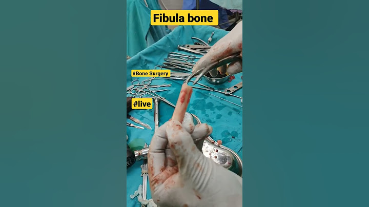Fibula Bone Graft | #fibula #fibulafracture #bonegraft #bonegrafting #bonesurgery #bonefracture #acl