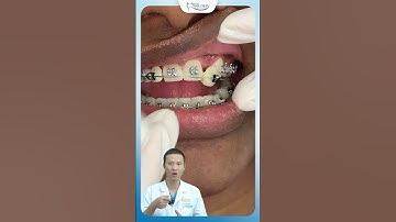 Mất Răng Có Niềng Được Không ? | Bác Sĩ Yên