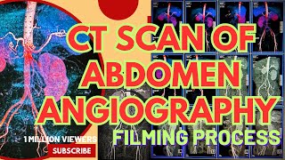 ABDOMEN ANGIOGRAPHY 3D and MIP FILMING PROCESS and BASICS DISCUSSION #abdomen #angiography #ctscan