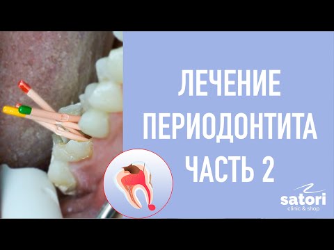 Видео: Корневой канал на переднем зубе: процедура, стоимость и многое другое
