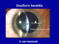 Cornea : 2d Corneal ulcer- infective ulcers