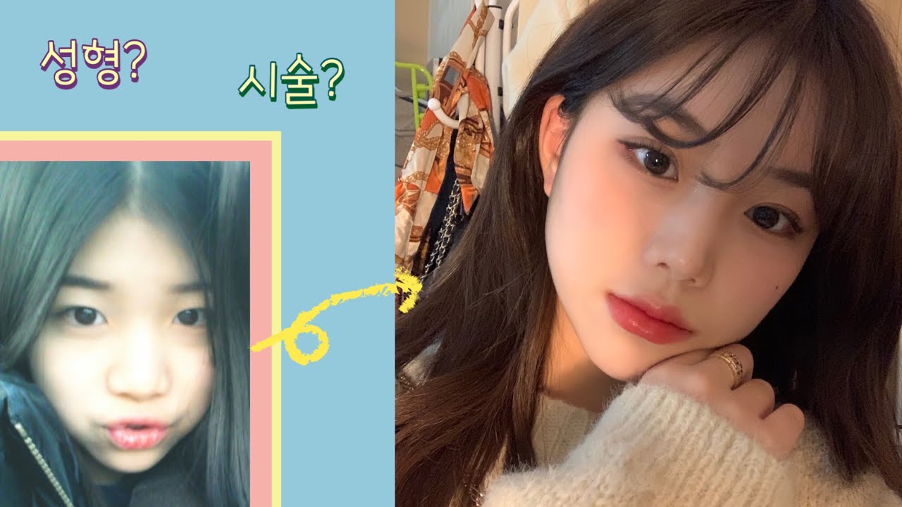 자연스럽게 예뻐지고 싶어서 한 성형 & 시술 후기! 너 자연 아니야? 🤫 다 알려드림 🫥 부작용, 고통, 추천 등