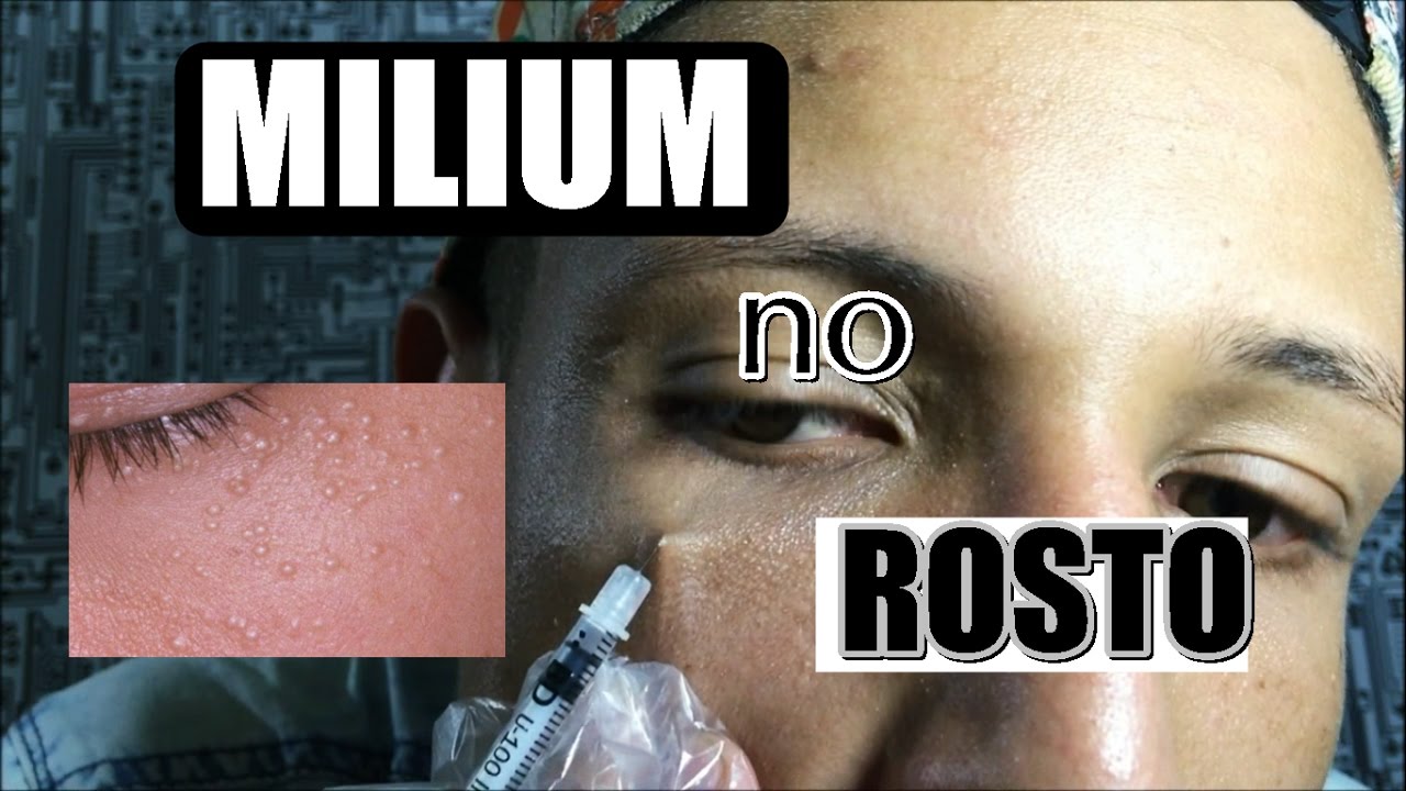 Como Tirar Milium Do Rosto : Milium no rosto: aprenda o que é e como ...