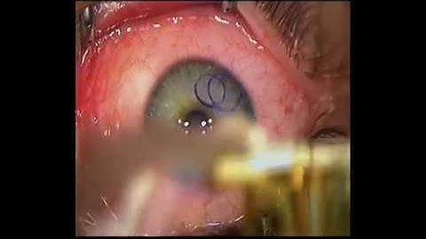 A corneal flap created with the Moria One-Use plus microkeratome /no comment/