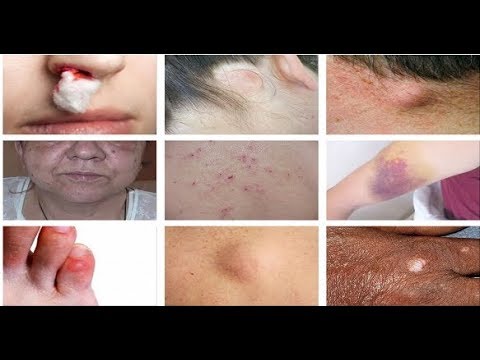 How to Recognize the Signs of Leukemia---Signs of Leukemia - YouTube