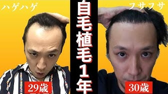 植毛 Youtube 植毛 Youtube