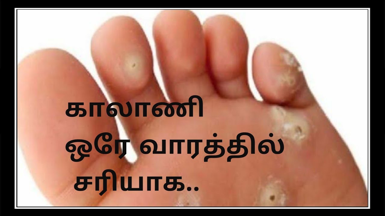 காலாணி ஒரே வாரத்தில் சரியாக corn foot removal at home in tamilkaalanicornfootகாலாணி YouTube