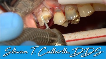 Sectioning Extraction and Bone Grafting - Dental Minute with Steven T. Cutbirth, DDS