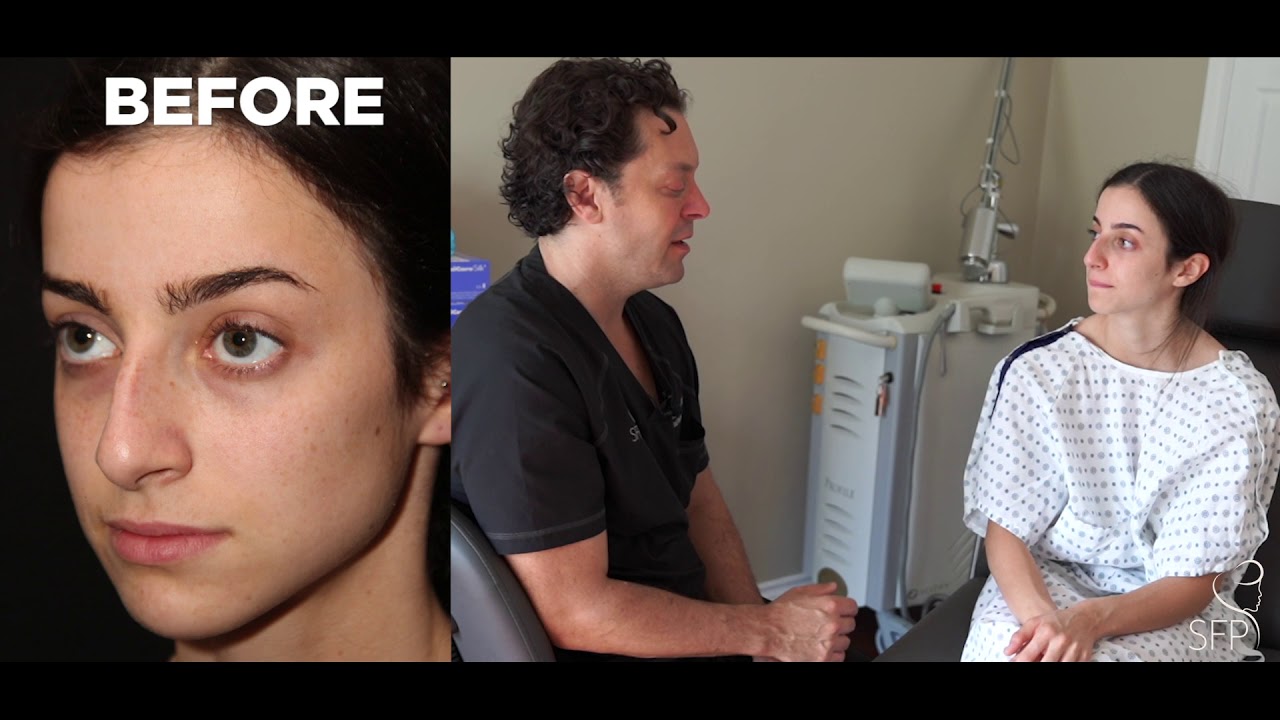 RHINOPLASTY BEFORE AND AFTER RESULTS, SPLINT REMOVAL WITH DR. PHILIP SOLOMON, TORONTO YouTube