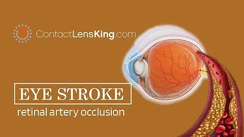Eye Stroke, Retinal Artery Occlusion, Retinal Vein Occlusion What Causes It? What are the Symptoms? - DayDayNews