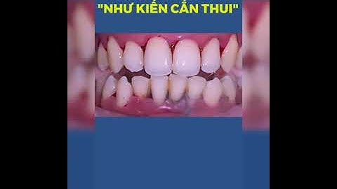 cạo vôi răng và tác hại của nó I Nha Khoa Smile HT #shorts