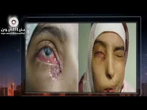 صور لزراعه القرنيه في العين
