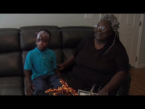 NC grandmother asks for kindness after people make rude comments about 6-year-old hurt in fire