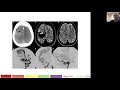 Therapeutic Cerebral, Head and Neck Angiography Part 1| Health4TheWorld Academy