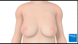 How breast reduction surgery is carried out