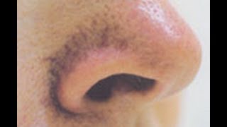 BEWARE: LARGE PORES FROM PORE STRIPS