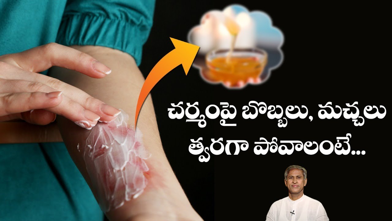 Tips to Reduce Skin Burn Marks Burn Blister Skin Infections Remedy Dr. Manthena's Health