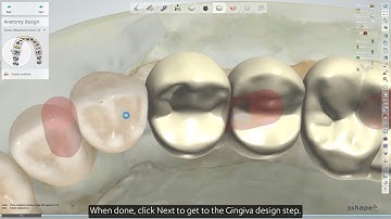 Performing an all-in-one implant bridge design