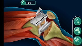 Fracture Operation | Free Clinic Doctor Patient | Multi Surgery Hospital Games screenshot 5