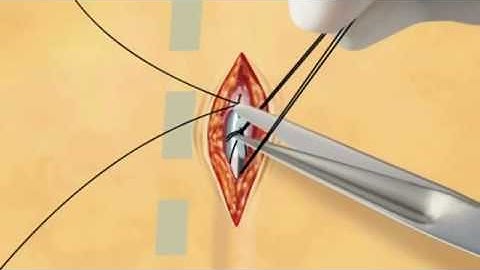 Bác sĩ phẫu thuật cấy máy tạo nhịp tim như thế nào