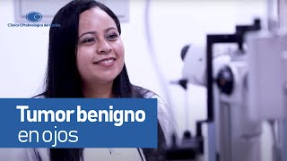 Tumor benigno en los ojos Consulta de oftalmologia
