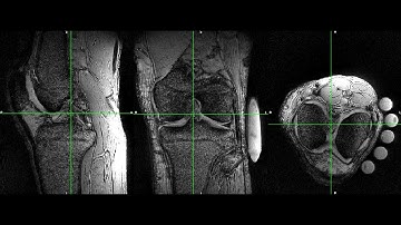 Cartilage MSK Imaging with Dual-echo 3D Rosette kspace trajectory
