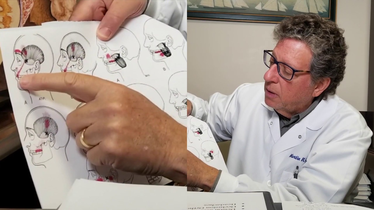 Correlation of TMJ, Dental Malocclusion, and Headaches (4 B's: Bite)