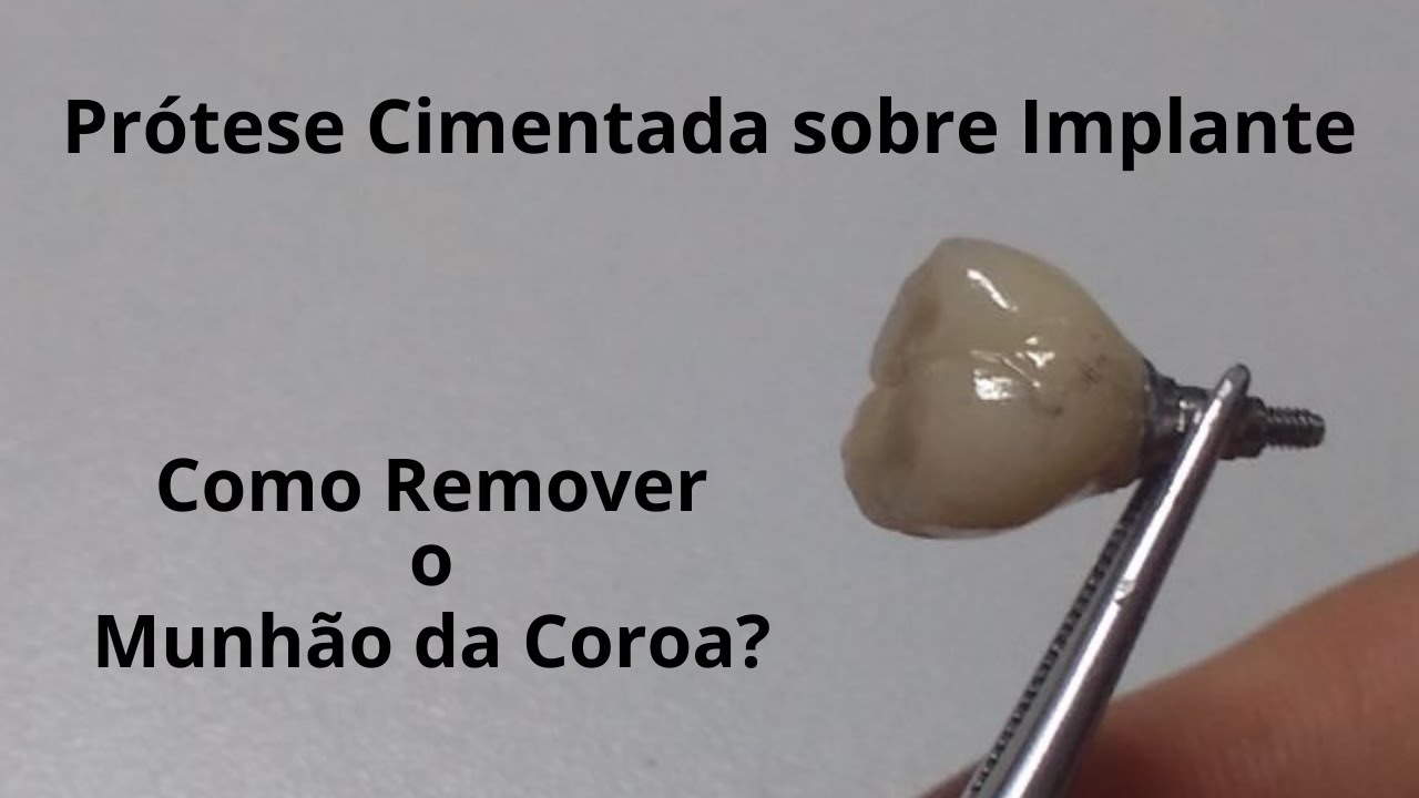 Soltou o Parafuso na Boca? Como Remover Munhão da Coroa s/Implante que já estava Cimentada
