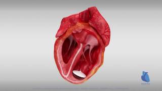 Animazione 3D Heart Damper™ Eucardia.