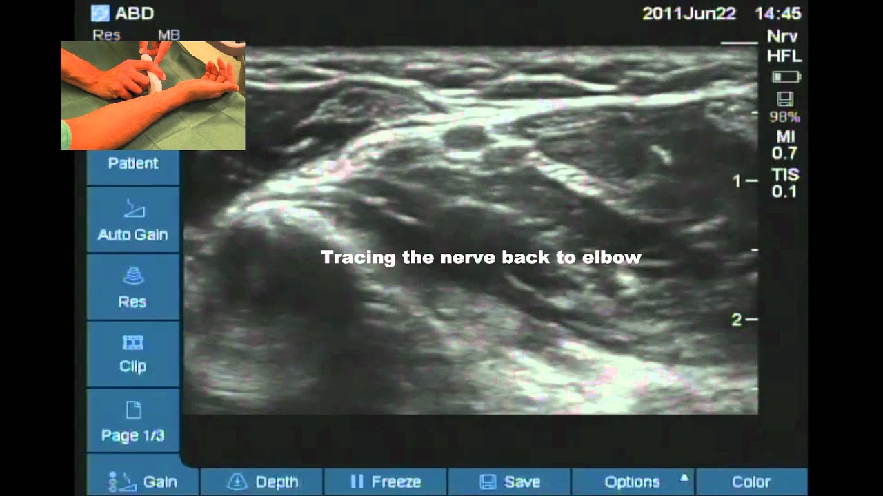 Ultrasound variation in anatomy of ulnar nerve: rt side - YouTube