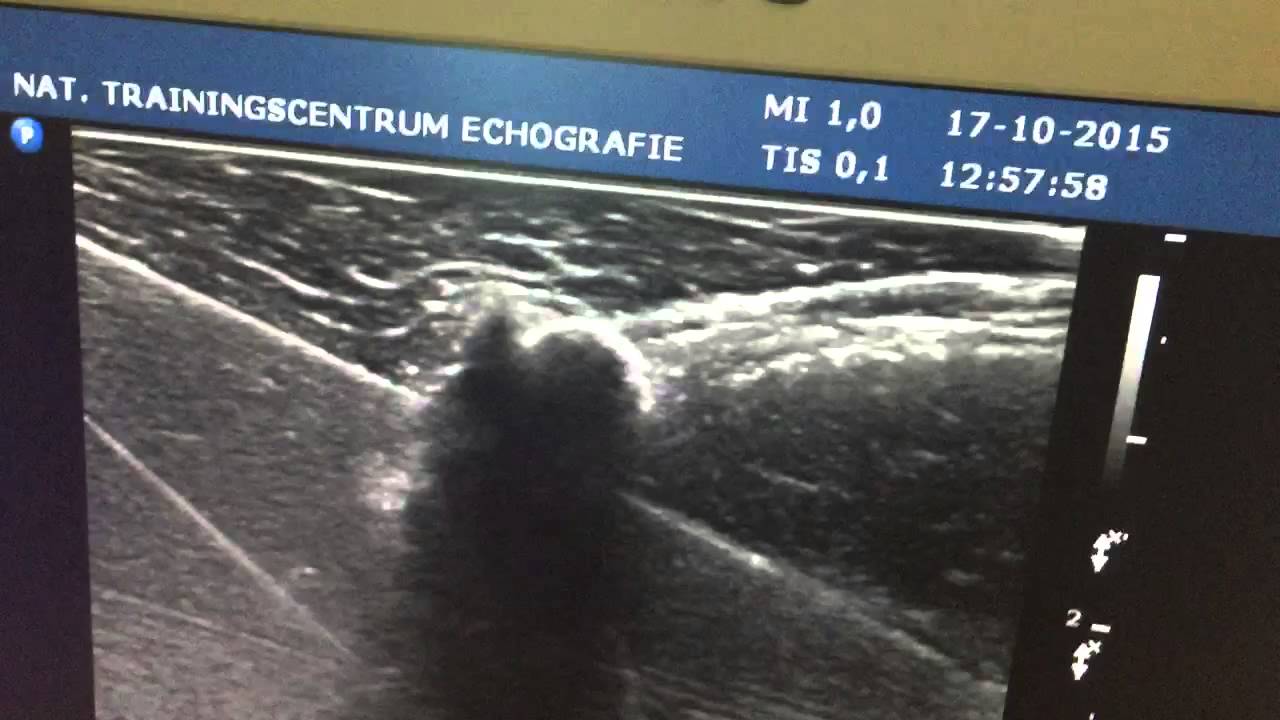 Practicing barbotage on ultrasound YouTube