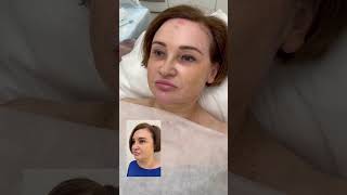 Подтяжка лица по авторской методике. Овал лица До и После
