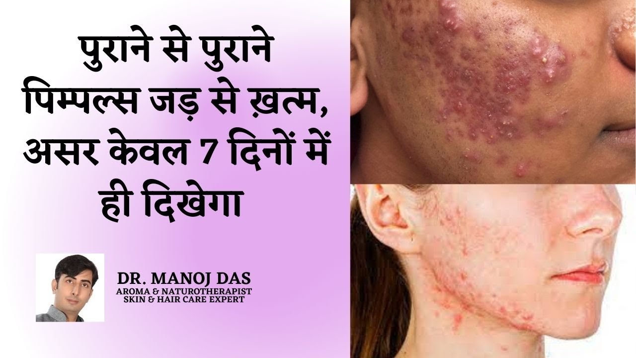 पुराने से पुराने पिम्पल्स जड़ से ख़त्म I GET RID OF PIMPLES AND ACNE PERMANANTLY | DR. MANOJ DAS