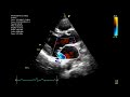 Echocardiographic assessment of the mitral valve