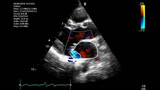 Echocardiographic assessment of the mitral valve