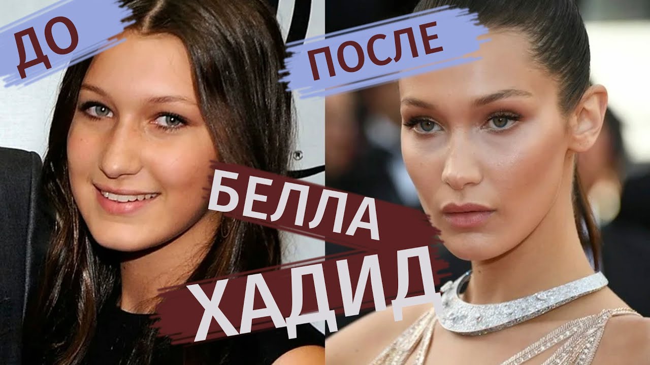 Пластика звёзд: ЧТО СДЕЛАЛА БЕЛЛА ХИДИД?!