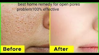 How to get rid fo large open pores permanently/ natural home remedies
in kannada