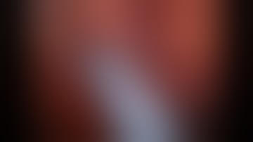 Left Robotic Partial Nephrectomy in Single kidney with ICG