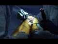 Partial Knee Replacement | Vail, CO