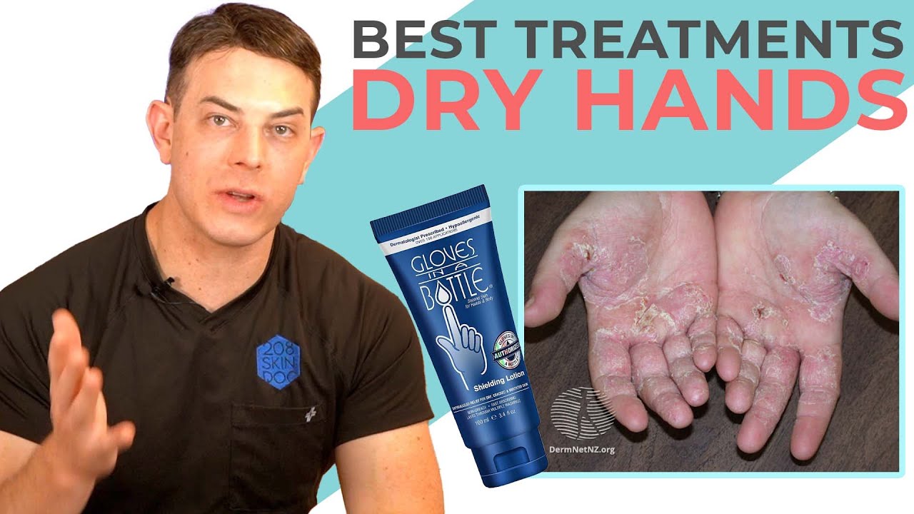 The Fix for Dry Hands! Hand Eczema YouTube