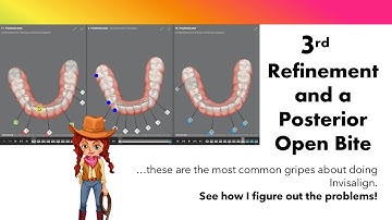 Invisalign ClinCheck - 3rd set of aligners! What to do NOW? And still a Posterior Open Bite!?!