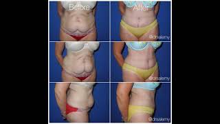 Plastic Surgery Before & 6 Weeks After Extended Tummy Tuck with Liposuction of Flanks #shorts