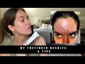 MY TRETINOIN RESULTS & TIPS | Rudi Berry