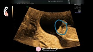 Boy fetus shows sex organ clearly on ultrasound, although he is only 11 weeks (2.5 months). Error?