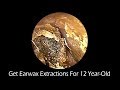 Get Earwax Extractions For 12 Year-Old