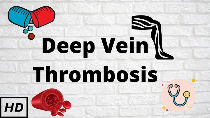Deep vein thrombosis, Causes, Signs and Symptoms, Diagnosis and Treatment.